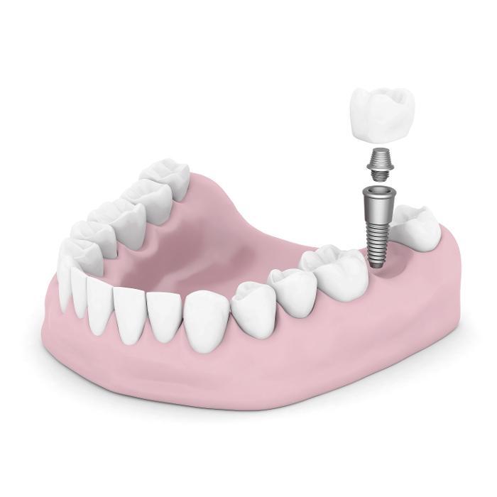 an illustration of a dental implants in Mount Pleasant, SC
