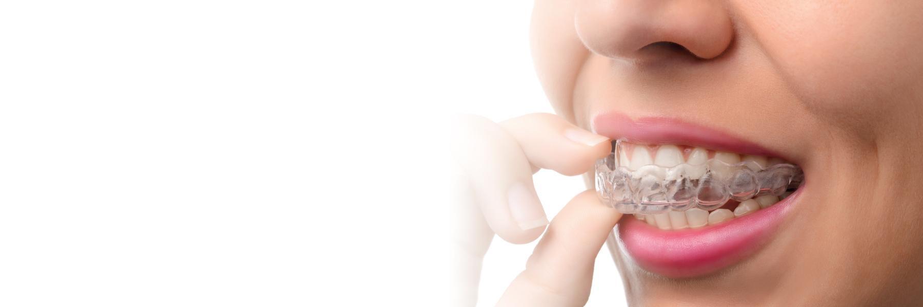 invisalign mount pleasant sc