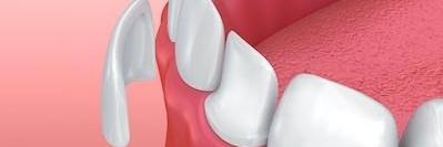 image of veneers at dentist in mount pleasant sc