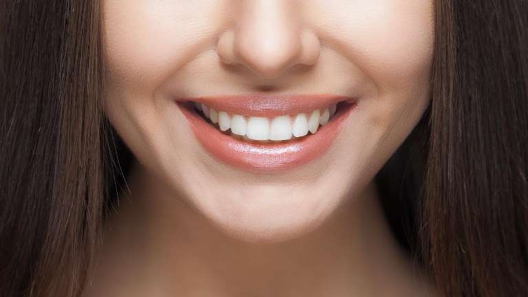 Dental bonded front teeth of a lady in Mount Pleasant SC
