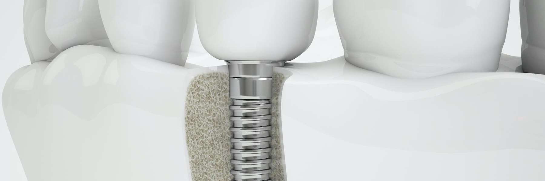 An illustration of a dental implant in Mount Pleasant, SC