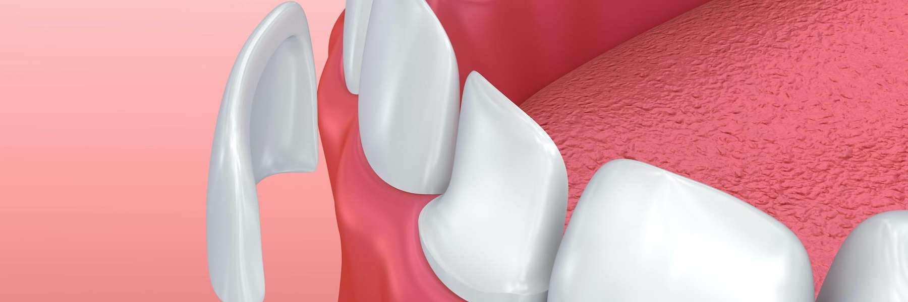 Dental veneers on lower front teeth in Mount Pleasant SC