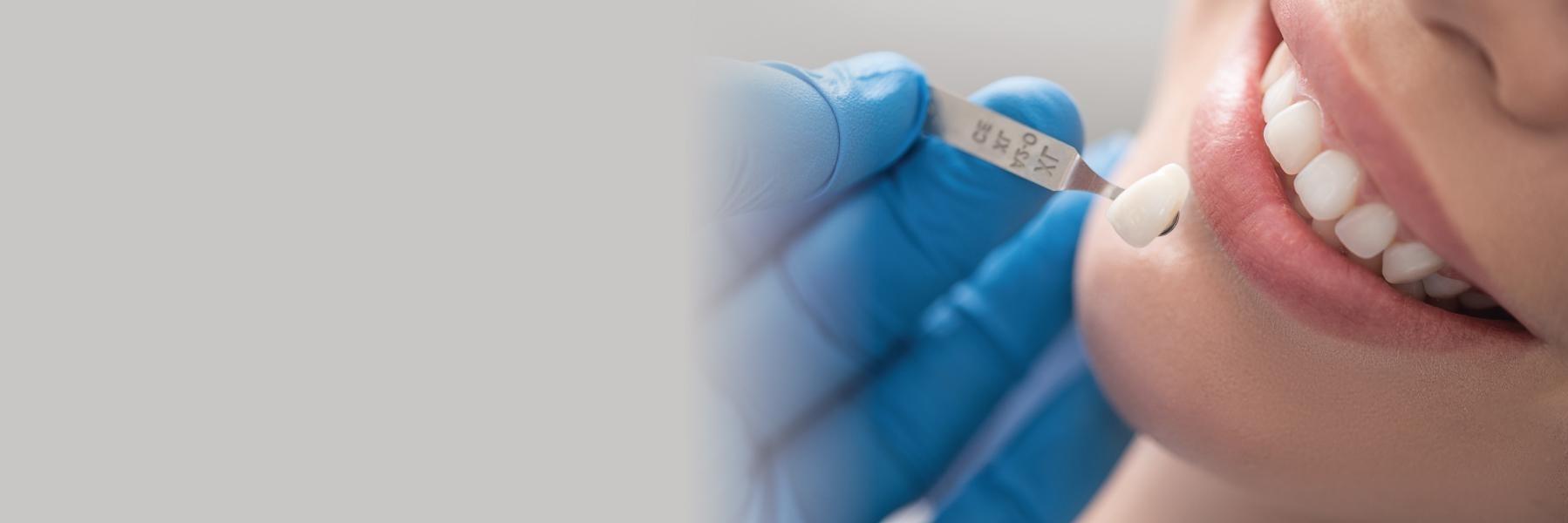 woman getting veneers in mount pleasant sc