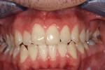 image of teeth before six month braces in mt pleasant sc