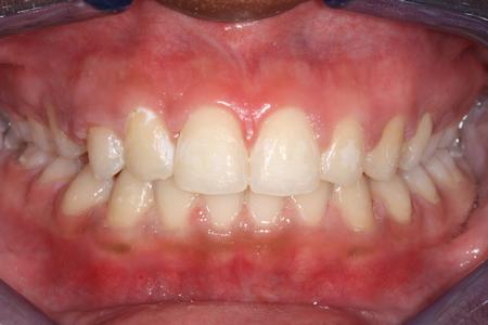 image of same teeth after six month braces in mt pleasant sc