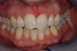 image of teeth before six month braces in mt pleasant sc