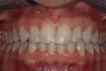 image of teeth after six month braces in mt pleasant sc