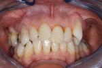 image of teeth before six month braces in mt pleasant sc