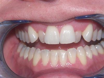 image of teeth before six month braces in mt pleasant sc
