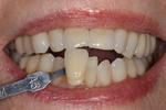 image of teeth before KOR bleaching