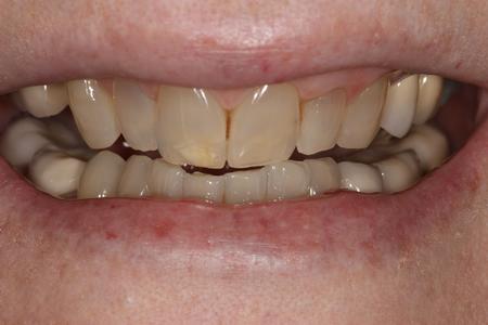image of teeth before deep bleaching mt pleasant sc