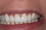 image of the same teeth after dental veneers in mt pleasant sc