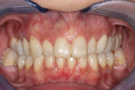 image of teeth before dental veneers in mt pleasant sc