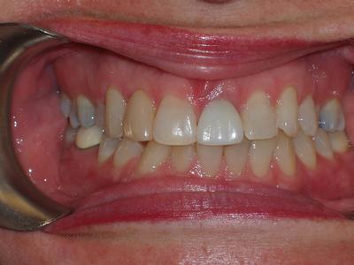 image of teeth before dental veneers in mt pleasant sc