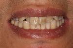 image of teeth before six month braces in mt pleasant sc