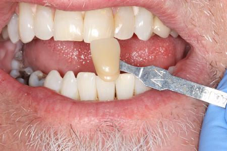 same teeth after KOR deep bleaching mt pleasant sc