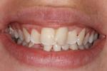 image of teeth before six month braces in mt pleasant sc