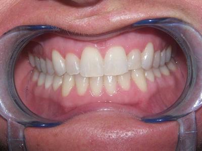image of same teeth after six month braces in mt pleasant sc