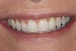 image of same teeth after six month braces in mt pleasant sc
