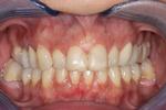 image of teeth before dental veneers in mt pleasant sc