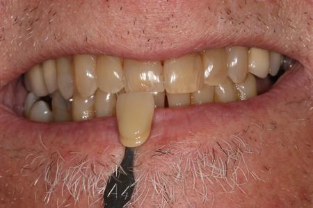 teeth before KOR deep bleaching mt pleasant sc
