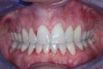 image of the same teeth after six month braces in mt pleasant sc