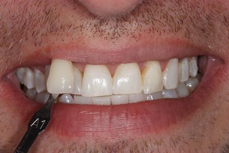 image of the same teeth after KOR whitening mt pleasant sc