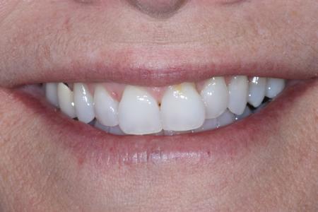 image of teeth before six month braces in mt pleasant sc