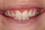 image of the same teeth after six month braces in mt pleasant sc
