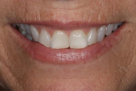 image of teeth before cosmetic crowns mt pleasant sc