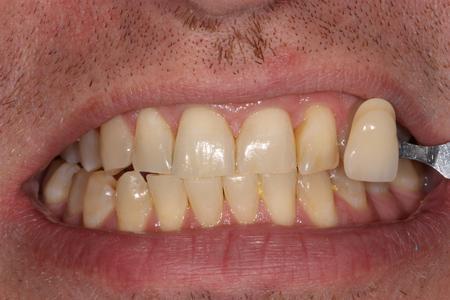 image of teeth before KOR whitening mt pleasant sc