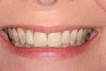 image of the same teeth after six month braces in mt pleasant sc