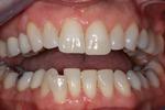 image of lower teeth before six month braces mt pleasant sc