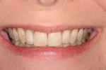 image of same teeth after orthodontics mt pleasant sc