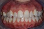 image of teeth before six month braces in mt pleasant sc