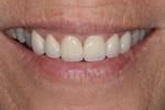 image of the same teeth after cosmetic crowns in mt pleasant sc