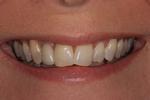 image of teeth before six month braces in mt pleasant sc