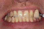 image of teeth before KOR whitening mt pleasant sc