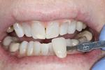 image of teeth after deep bleaching mt pleasant sc
