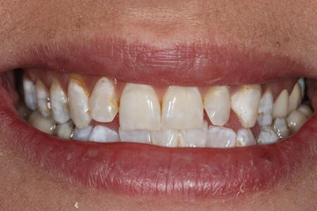image of teeth before dental veneers in mt pleasant sc