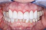 image of teeth after porcelain veneers in mt pleasant sc