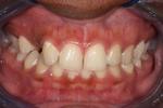 image of teeth before six month braces in mt pleasant sc