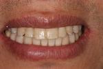 image of same teeth after six month braces in mt pleasant sc