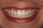 picture of same teeth after six month braces mt pleasant sc