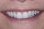 image of teeth before six month braces in mt pleasant sc