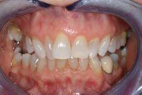 image of teeth before six month braces | mt pleasant sc