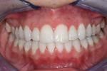 image of teeth after six month braces | mt pleasant sc
