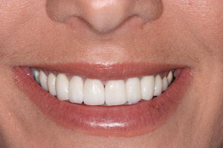 image of same teeth after dental veneers in mt pleasant sc