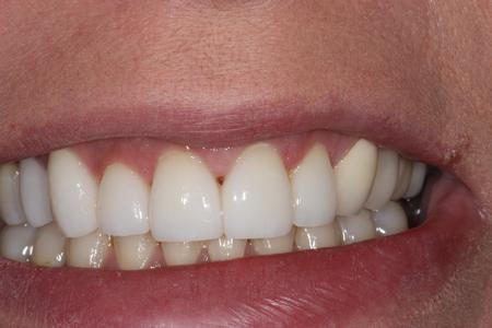 image of the same teeth after dental veneers in mt pleasant sc