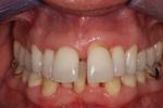 image of teeth before six month braces in mt pleasant sc